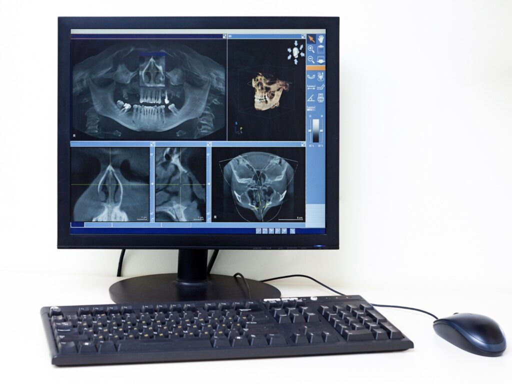 A clinic monitor displaying a four-panel dental CBCT scan of a jaw.