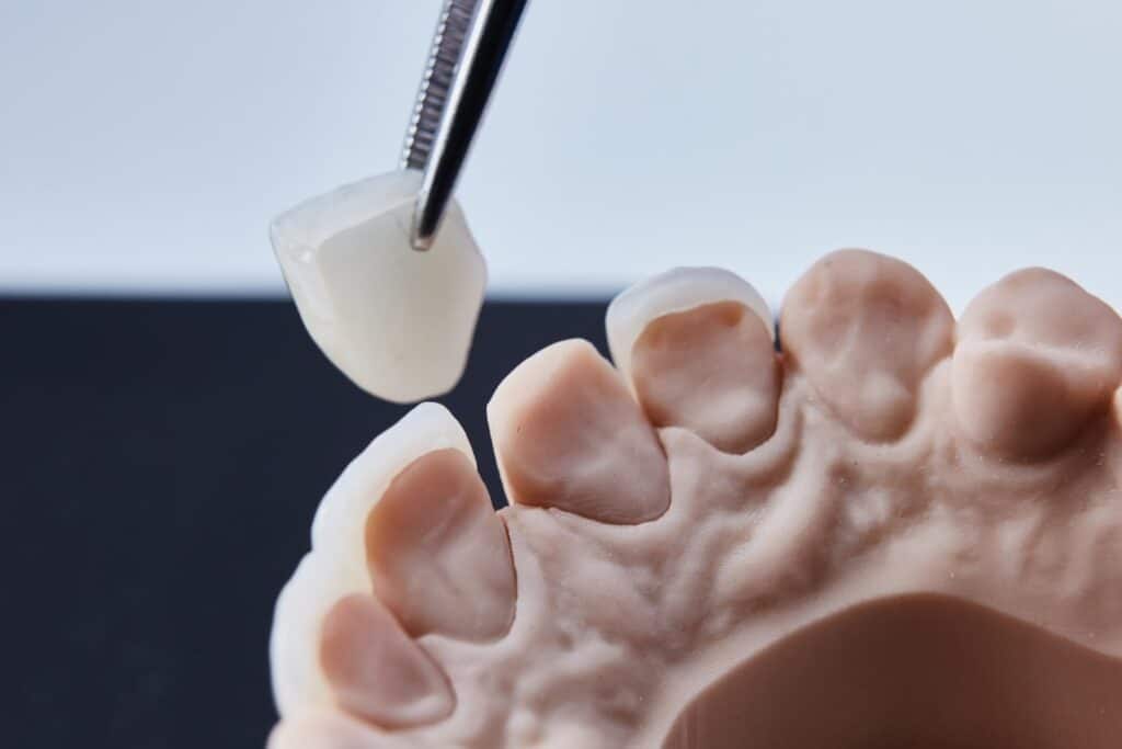 A single ceramic veneer held in tweezers above a plaster model of an upper dental arch in a dental laboratory.